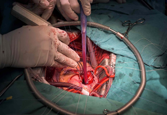 Coronary artery bypass graft surgery
