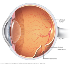 Retinal detachment surgery image