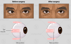 Strabismus surgery image
