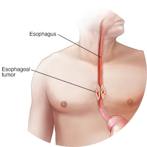 Esophageal cancer