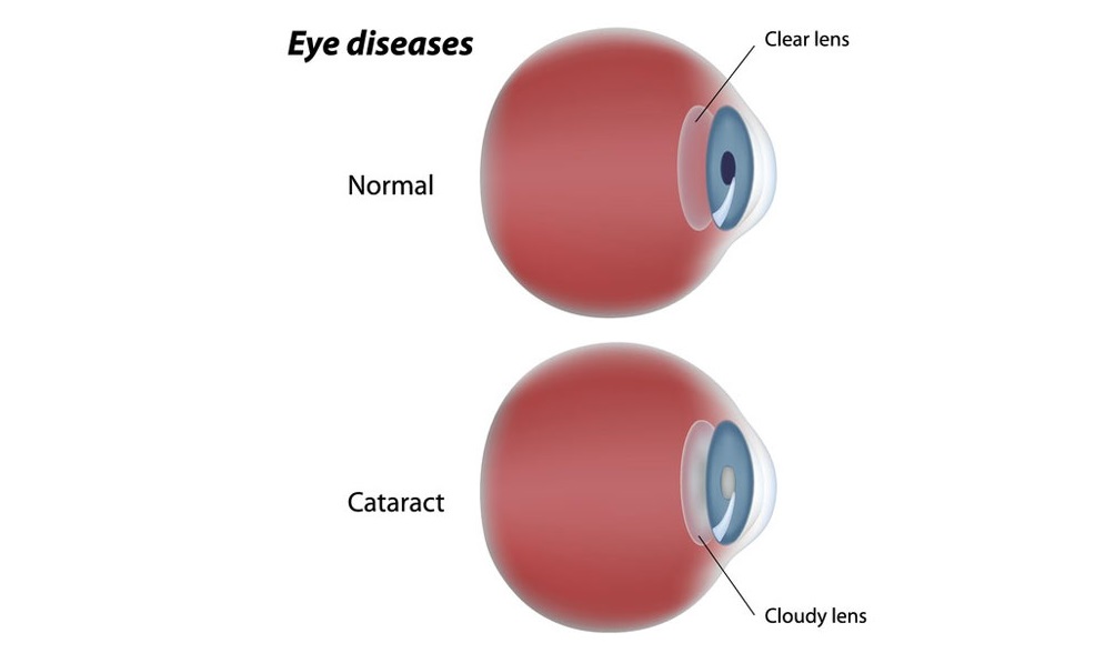 Cataract Surgery - جراحة الساد