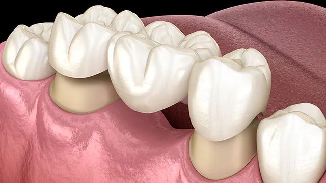 dental crowns in Iran - تيجان الأسنان في إيران