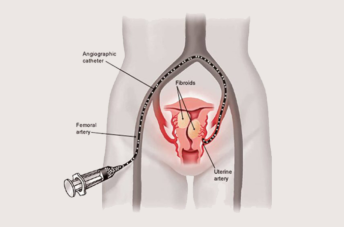 Discover Uterine Artery Embolization - جراحة استئصال الرحم
